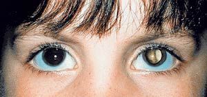 eye-cancer_1.jpg