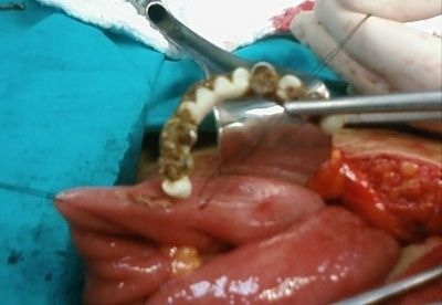 denture.jpg