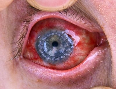 cornea-20transplant.jpg