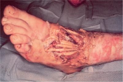 acidfoot.jpg
