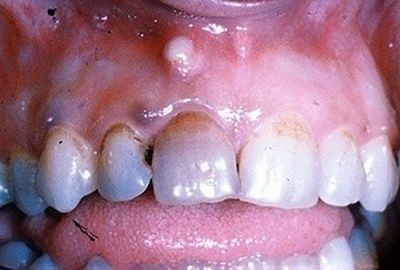 parulis-20-28alveolar-20abscess-29.jpg