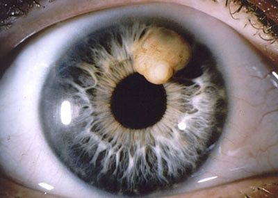 iris-20cyst.jpg