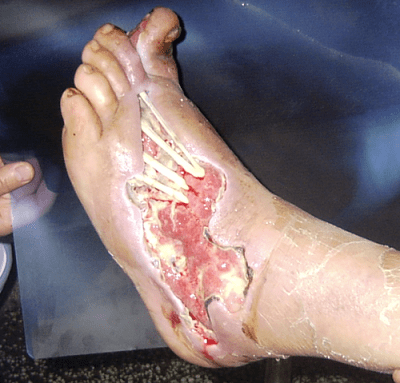 ulcer.png