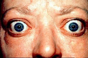 Proptosis_and_lid_retraction_from_Graves%27_Disease.jpg