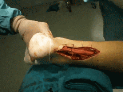 achilles-20tendon-20surgery.gif