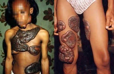 keloids.jpg