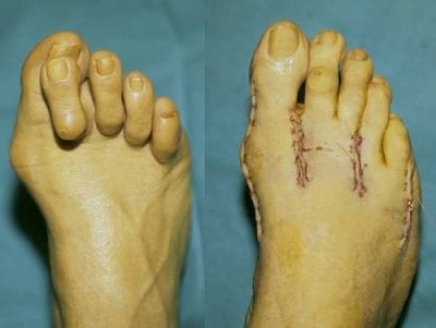 correction-20of-20severe-20claw-20toes.jpg