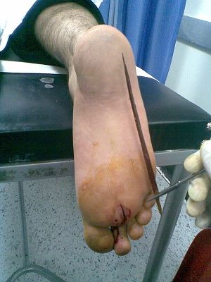 splinter.jpg