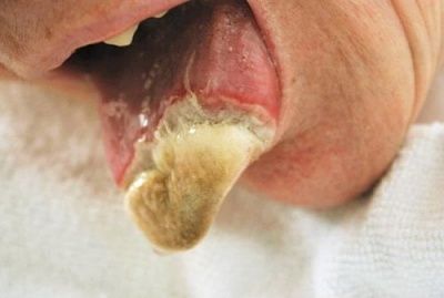 tongue-20necrosis-20in-20a-20patient-20with-20essential-20thrombocytosis.jpg