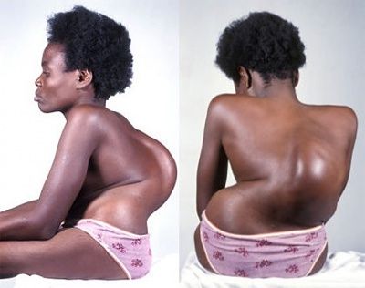 spinal-20deformity-20from-20polio.jpg