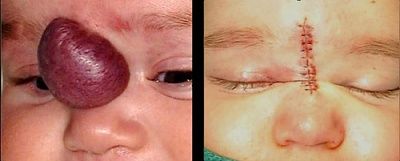 hemangioma-20removal.jpg