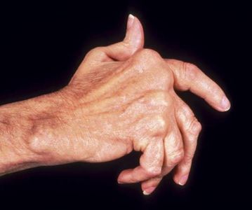 article-new_ehow_images_a05_17_4g_diet-severe-arthritis-800x800.jpg