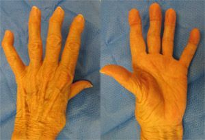 severe-arthritis-of-thumb.jpg