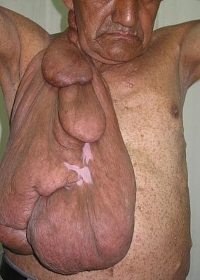 neurofibromatosis.jpg