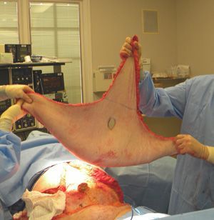 Abdominoplasty%20%281%29.jpg