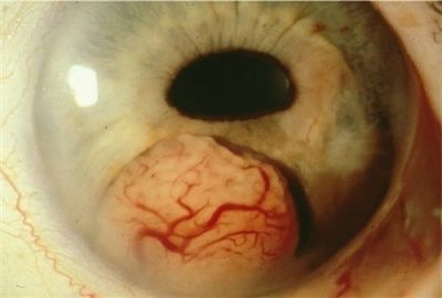 tumor-20on-20the-20iris.jpg