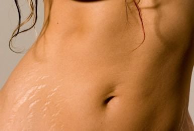 how-to-get-rid-of-stretch-marks.jpg