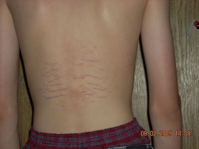 PIcture-Of-Strecth-mark-on-back-1.jpg