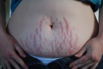 stretchmarks.jpg
