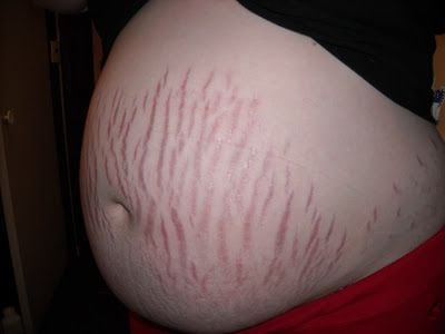 Stretch-Marks1.jpg