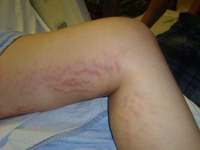 stretch-marks-thighs.jpg