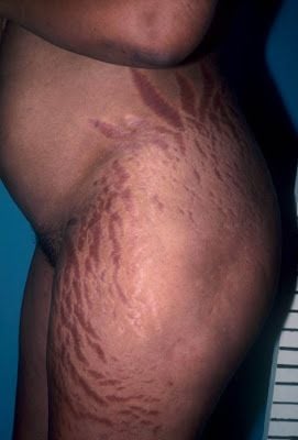 striae_6_020727.jpg