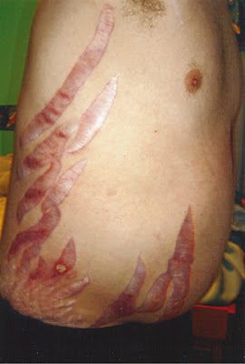 stretchmarks.jpg