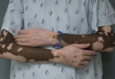 vitiligo.jpg