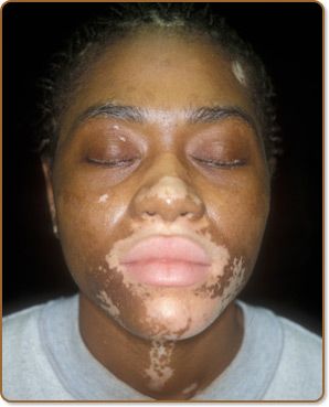 vitiligo_c_p_AFTER.jpg