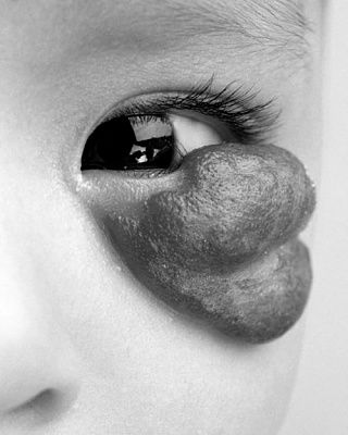 haemangioma.jpg