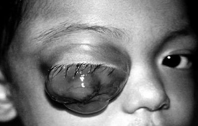 eye-20tumor..jpg