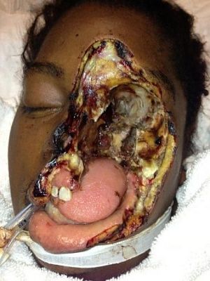 face-20ate-20up-20with-20cancer.jpg