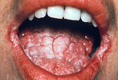 oral-candidiasis.gif