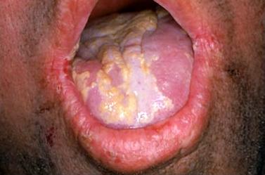 oral candidiasis4.jpg