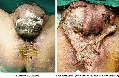 gangrene-testicles.jpg