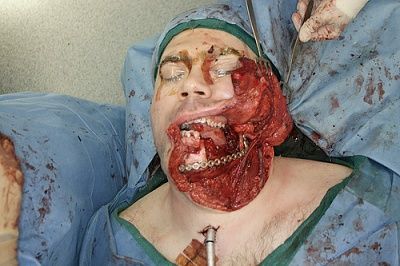 oral-20cancer-20-281-29.jpg