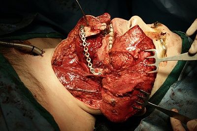 oral-20cancer-20-282-29.jpg