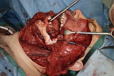 oral-20cancer-20-283-29.jpg