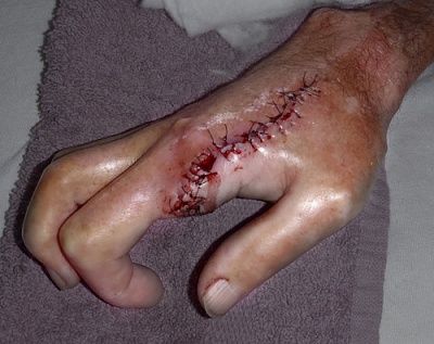 amputation-20of-20index-20finger..jpg