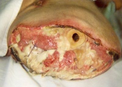 bone-20erosion.jpg