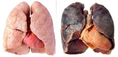 healthy-20lungs-20compared-20to-20smoker-e2-80-99s-20lungs.jpg