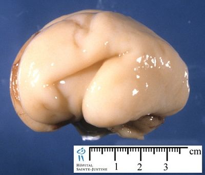 fetal-20brain-20-2822-20weeks-29.jpg
