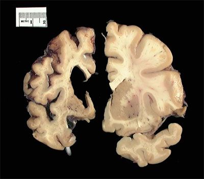 huntington-e2-80-99s-20disease-20affected-20brain-20vs-20normal-20brain..jpg