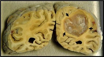 brain-20cancer..jpg
