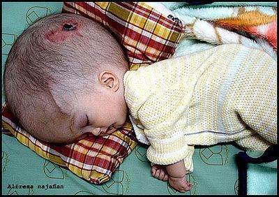 baby-20suffering-20from-20hydrocephalus.jpg