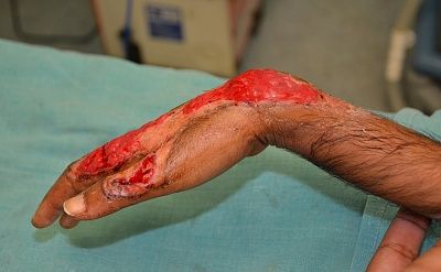 demonstrating-20wrist-20drop-20due-20to-20loss-20of-20wrist-20extensors.jpg
