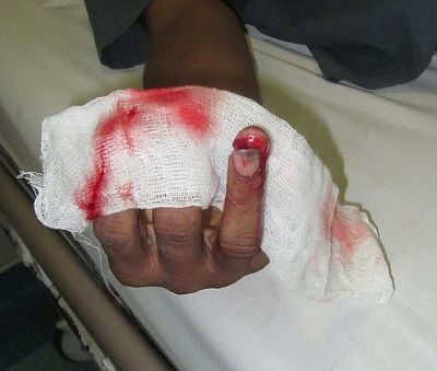 inotial-20injury.jpg