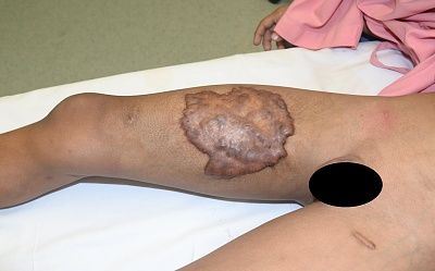 thigh-201.jpg