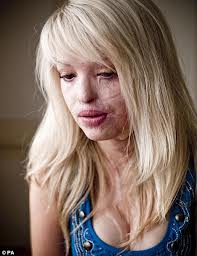 AcidattackKatiePiperafter.jpg