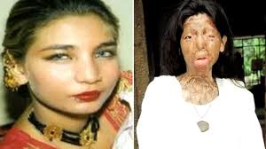 AcidAttackPakistanFakhra.jpg